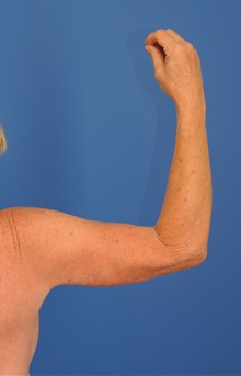 Arm Lift After Photo by Kelly Tjelmeland, MD; Austin, TX - Case 39601