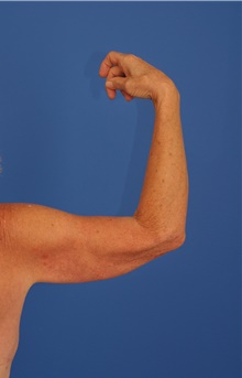 Arm Lift Before Photo by Kelly Tjelmeland, MD; Austin, TX - Case 39601