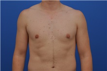 Male Breast Reduction After Photo by Kelly Tjelmeland, MD; Austin, TX - Case 39637