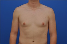 Male Breast Reduction Before Photo by Kelly Tjelmeland, MD; Austin, TX - Case 39637