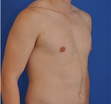Male Breast Reduction After Photo by Kelly Tjelmeland, MD; Austin, TX - Case 39637