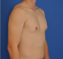 Male Breast Reduction Before Photo by Kelly Tjelmeland, MD; Austin, TX - Case 39637