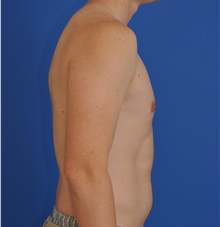 Male Breast Reduction After Photo by Kelly Tjelmeland, MD; Austin, TX - Case 39637