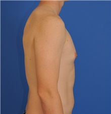 Male Breast Reduction Before Photo by Kelly Tjelmeland, MD; Austin, TX - Case 39637