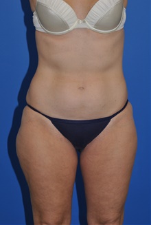 Liposuction Before Photo by Kelly Tjelmeland, MD; Austin, TX - Case 39727