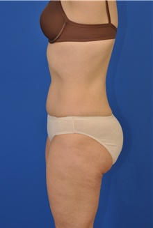 Liposuction After Photo by Kelly Tjelmeland, MD; Austin, TX - Case 39727