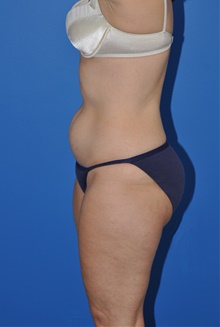 Liposuction Before Photo by Kelly Tjelmeland, MD; Austin, TX - Case 39727