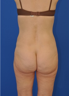 Liposuction After Photo by Kelly Tjelmeland, MD; Austin, TX - Case 39727