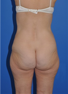 Liposuction Before Photo by Kelly Tjelmeland, MD; Austin, TX - Case 39727