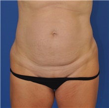 Tummy Tuck Before Photo by Kelly Tjelmeland, MD; Austin, TX - Case 40435