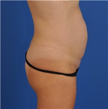 Tummy Tuck Before Photo by Kelly Tjelmeland, MD; Austin, TX - Case 40435