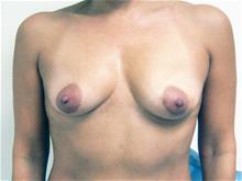 Breast Augmentation Before Photo by Keith Berman, MD; Aventura, FL - Case 29330