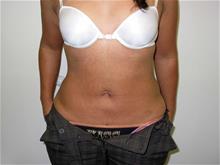Liposuction After Photo by Keith Berman, MD; Aventura, FL - Case 29332