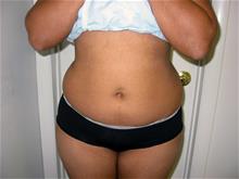 Liposuction Before Photo by Keith Berman, MD; Aventura, FL - Case 29332