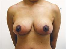 Breast Lift After Photo by Keith Berman, MD; Aventura, FL - Case 29337