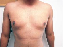 Male Breast Reduction After Photo by Keith Berman, MD; Aventura, FL - Case 29340