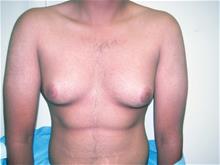 Male Breast Reduction Before Photo by Keith Berman, MD; Aventura, FL - Case 29340