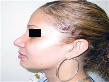 Rhinoplasty After Photo by Keith Berman, MD; Aventura, FL - Case 29343