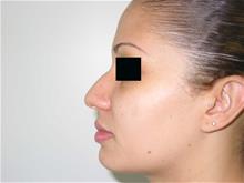 Rhinoplasty Before Photo by Keith Berman, MD; Aventura, FL - Case 29343