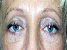 Eyelid Surgery After Photo by Keith Berman, MD; Aventura, FL - Case 29345