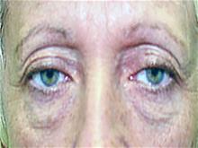 Eyelid Surgery Before Photo by Keith Berman, MD; Aventura, FL - Case 29345