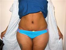 Tummy Tuck After Photo by Keith Berman, MD; Aventura, FL - Case 29346