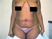 Tummy Tuck Before Photo by Keith Berman, MD; Aventura, FL - Case 29346