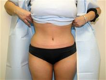 Tummy Tuck After Photo by Keith Berman, MD; Aventura, FL - Case 29347