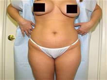 Tummy Tuck Before Photo by Keith Berman, MD; Aventura, FL - Case 29347