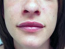 Lip Augmentation/Enhancement After Photo by Keith Berman, MD; Aventura, FL - Case 29351