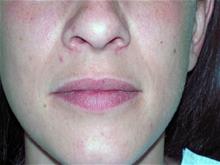 Lip Augmentation/Enhancement Before Photo by Keith Berman, MD; Aventura, FL - Case 29351