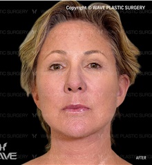 Facelift After Photo by Peter Lee, MD, FACS; Los Angeles, CA - Case 30840