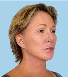 Facelift After Photo by Peter Lee, MD, FACS; Los Angeles, CA - Case 30840