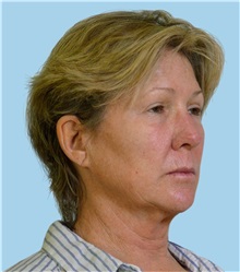 Facelift Before Photo by Peter Lee, MD, FACS; Los Angeles, CA - Case 30840