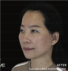 Facelift After Photo by Peter Lee, MD, FACS; Los Angeles, CA - Case 46535