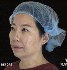 Facelift Before Photo by Peter Lee, MD, FACS; Los Angeles, CA - Case 46535