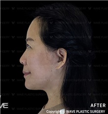 Facelift After Photo by Peter Lee, MD, FACS; Los Angeles, CA - Case 46535