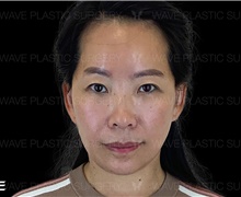 Facelift After Photo by Peter Lee, MD, FACS; Los Angeles, CA - Case 46535