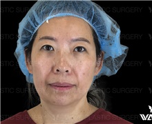 Facelift Before Photo by Peter Lee, MD, FACS; Los Angeles, CA - Case 46535