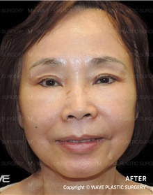 Facelift After Photo by Peter Lee, MD, FACS; Los Angeles, CA - Case 46537