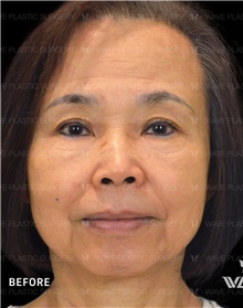 Facelift Before Photo by Peter Lee, MD, FACS; Los Angeles, CA - Case 46537