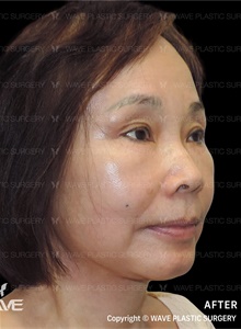 Facelift After Photo by Peter Lee, MD, FACS; Los Angeles, CA - Case 46537