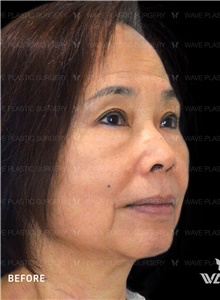 Facelift Before Photo by Peter Lee, MD, FACS; Los Angeles, CA - Case 46537