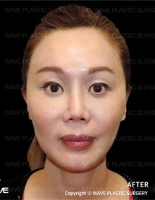 Facelift After Photo by Peter Lee, MD, FACS; Los Angeles, CA - Case 46540