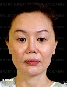 Facelift Before Photo by Peter Lee, MD, FACS; Los Angeles, CA - Case 46540