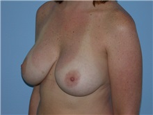 Breast Augmentation After Photo by Gerard Mosiello, MD; Tampa, FL - Case 20101
