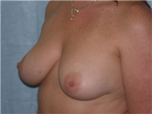 Breast Augmentation Before Photo by Gerard Mosiello, MD; Tampa, FL - Case 20101