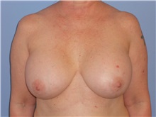 Breast Augmentation After Photo by Gerard Mosiello, MD; Tampa, FL - Case 23626