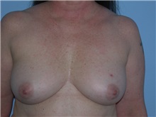 Breast Augmentation Before Photo by Gerard Mosiello, MD; Tampa, FL - Case 23626