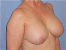 Breast Augmentation After Photo by Gerard Mosiello, MD; Tampa, FL - Case 23626